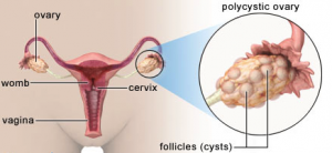 Polikistik Over Sendromu (PCOS)
