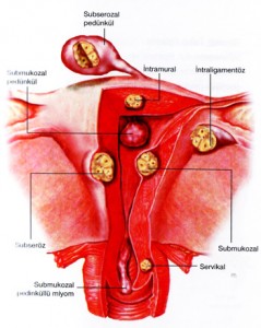Myoma Uteri (Rahmin İyi Huylu Tümörü)