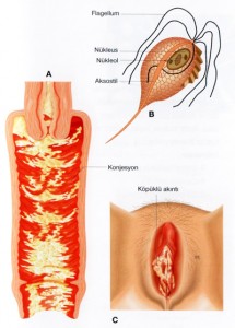 Vaginal Akıntılar (Trikomoniyaz)