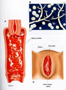 Vaginal Akıntılar (Mantar)