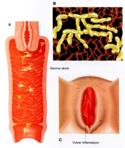 Vaginal Akıntı (Vajinozis)